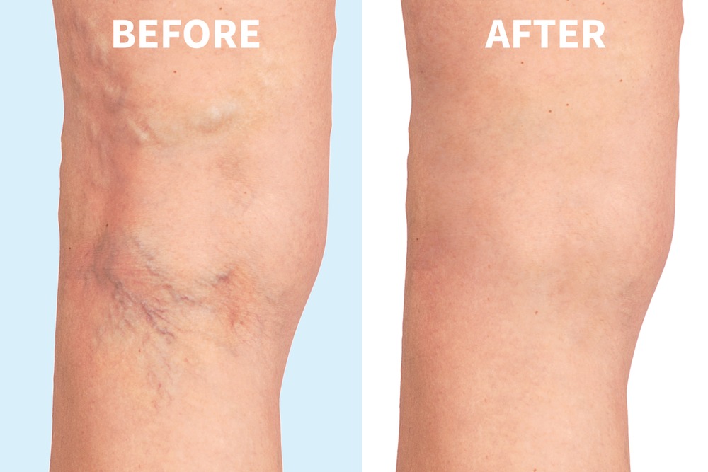 How To Get Rid Of My Varicose Veins?