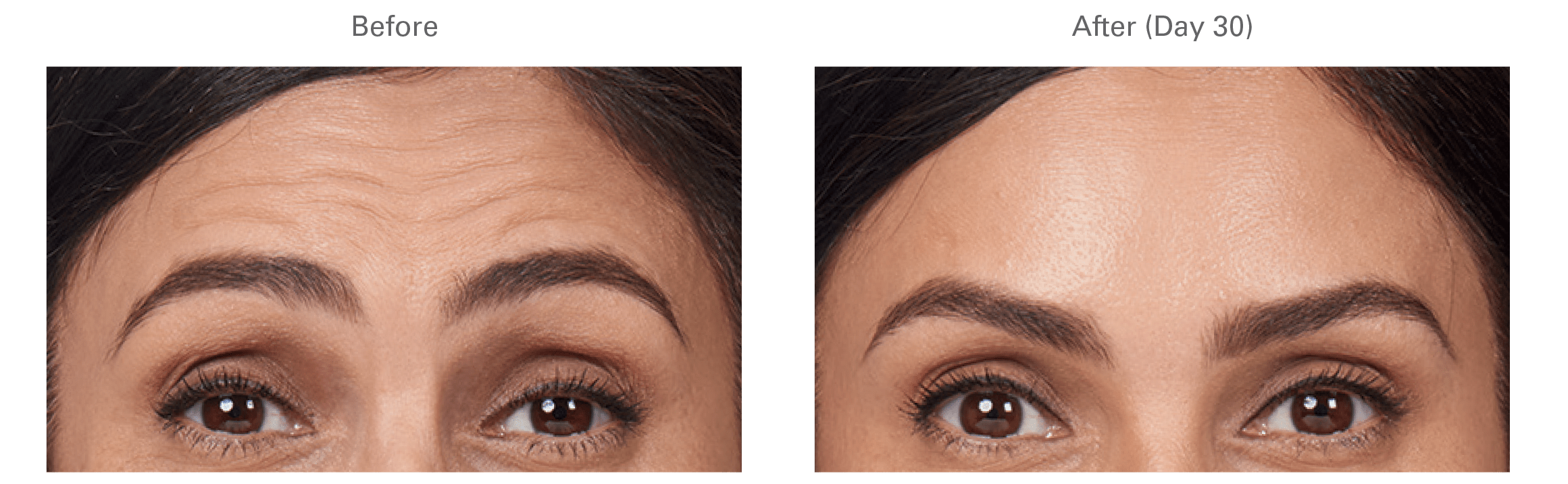 Botox Before and After Culver City 1
