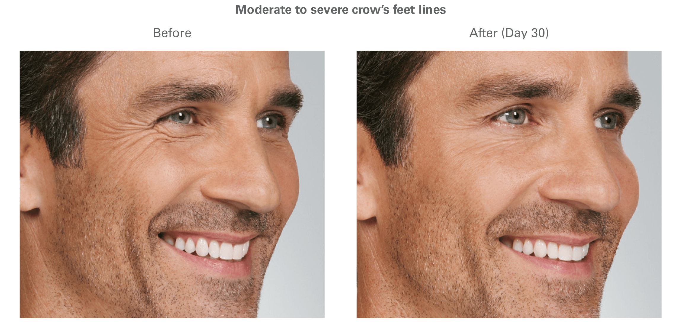 Botox Before and After Culver City 7