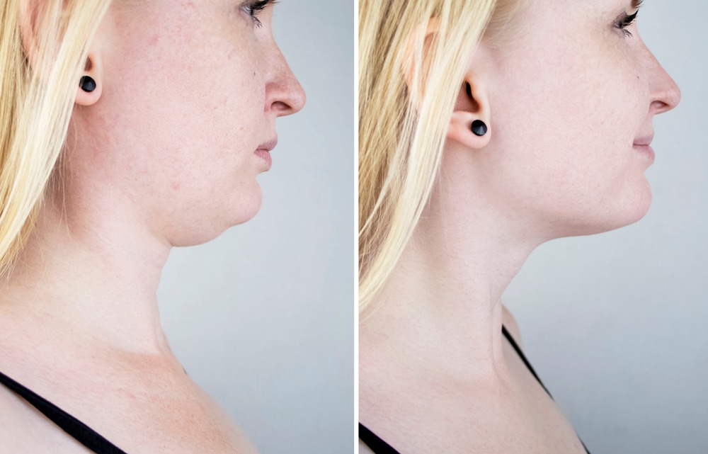 Say Goodbye To Your Double Chin With Kybella