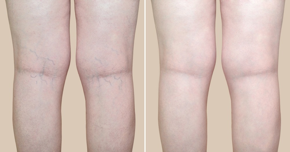 What Is Sclerotherapy For Spider Veins?