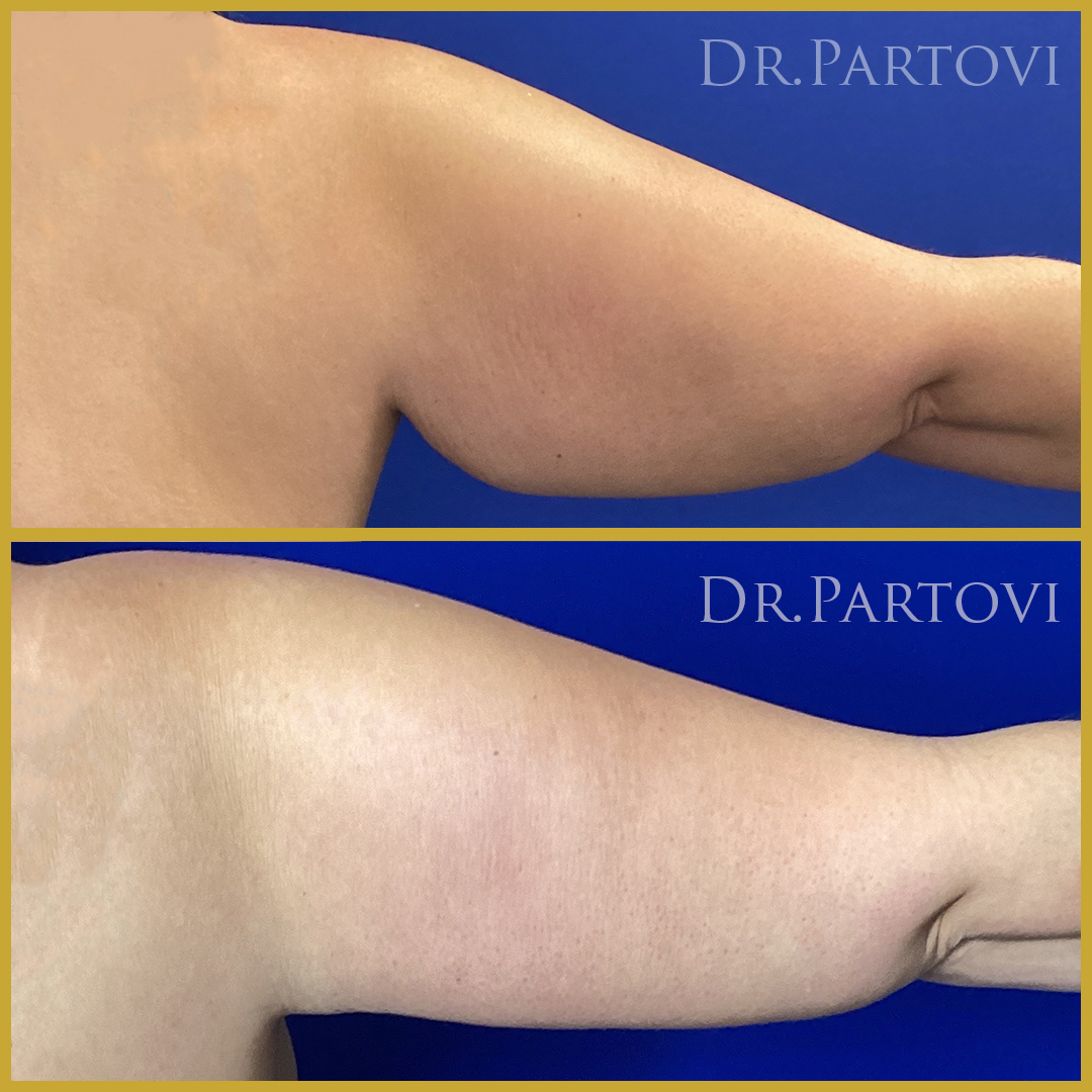 Achieve Toned and Youthful Arms with Arm Lift Surgery (Brachioplasty)