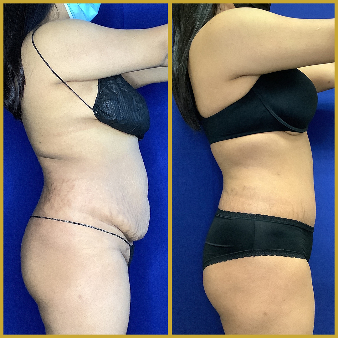 Top 3 Ways to Maintain Your Tummy Tuck Results