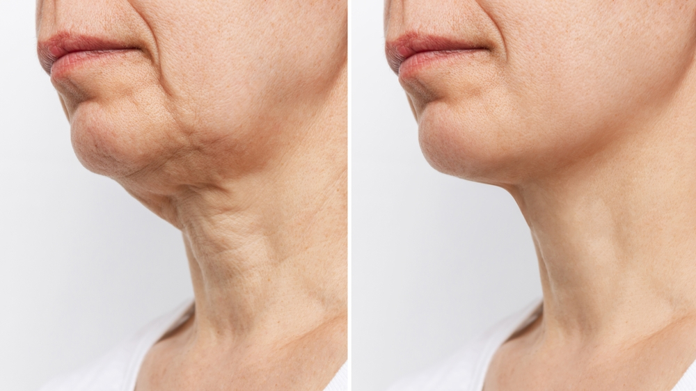 Neck Lift Plastic Surgery In Culver City, CA | True Jewel Surgical Center