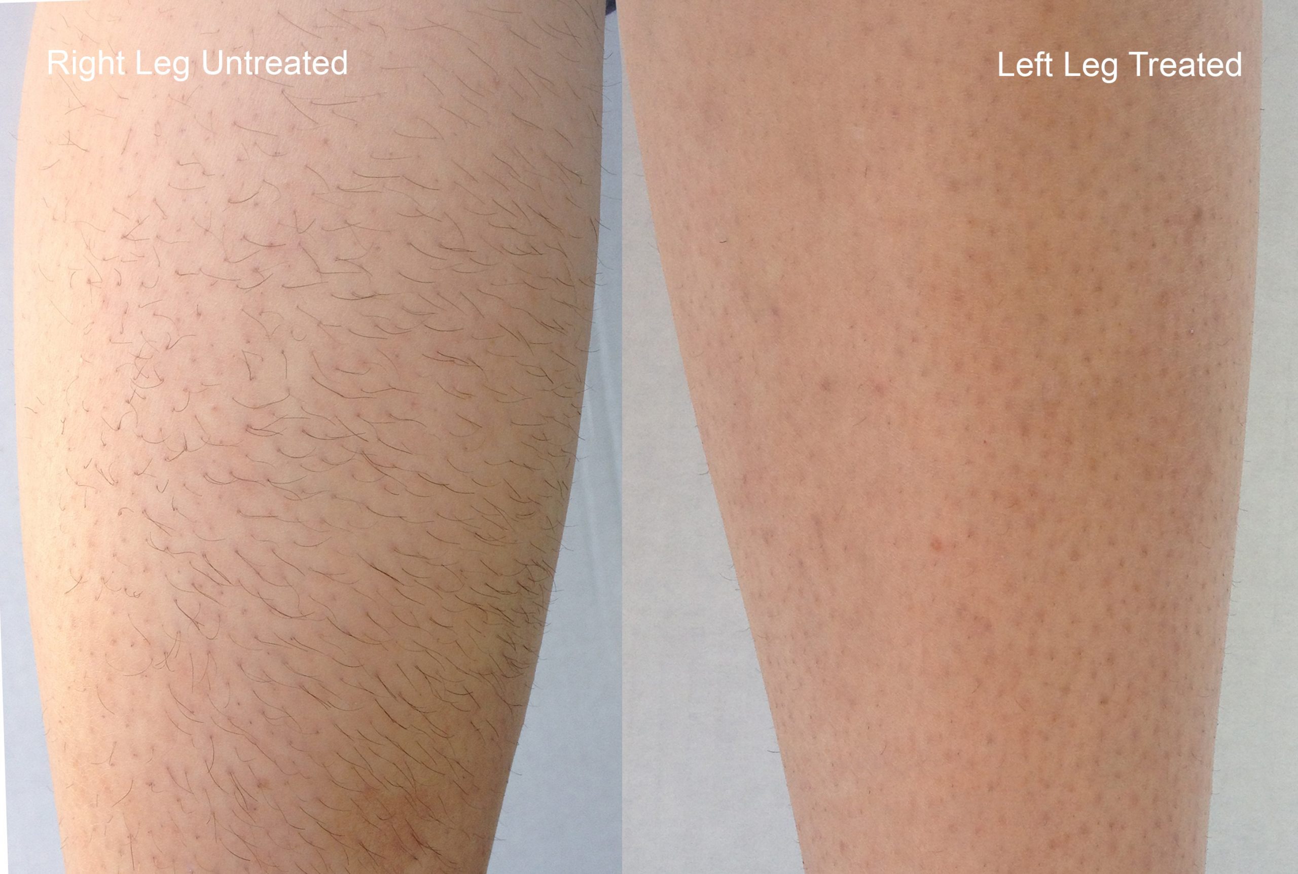 What Is The Cost Of Laser Hair Removal in Miami? - Solea Medical Spa