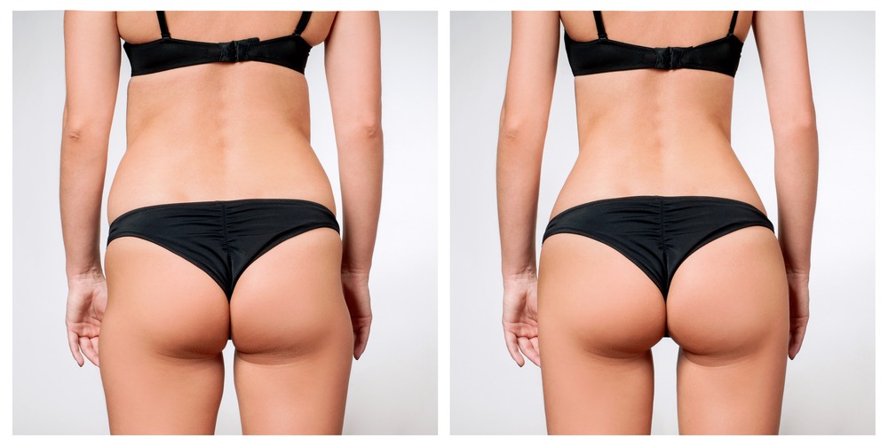 NON-SURGICAL BUTT-LIFT WITH SCULPTRA AND RADIESSE