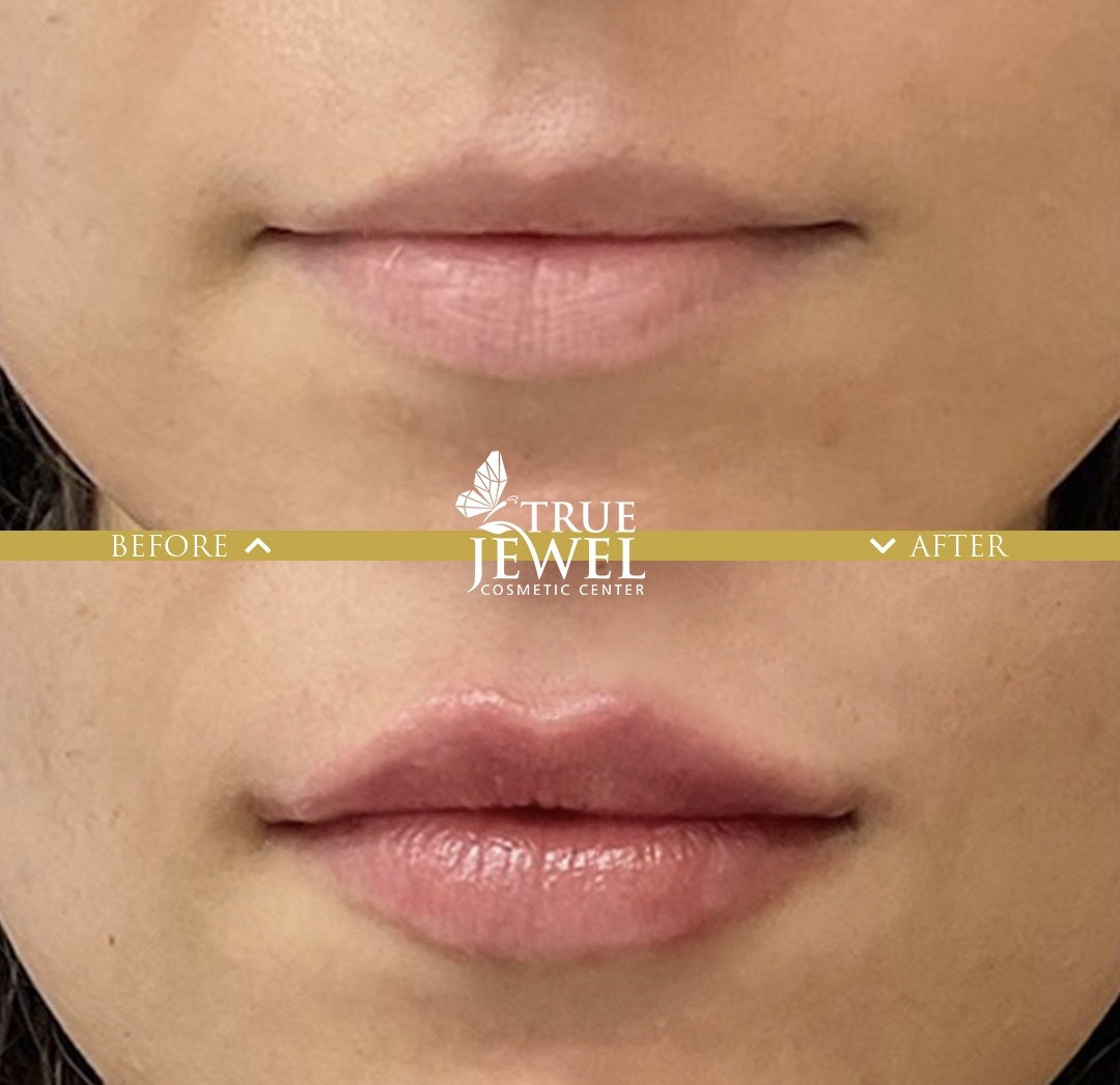 Luscious Lips Unleashed: Lip Treatments at True Jewel