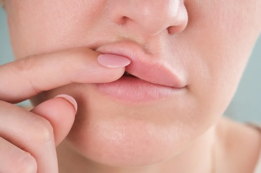 ¿Conoce los signos de migración del relleno?