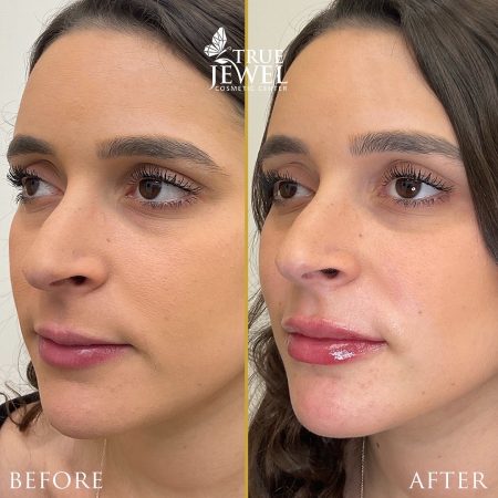 Culver City Lip Filler Before and After 00001