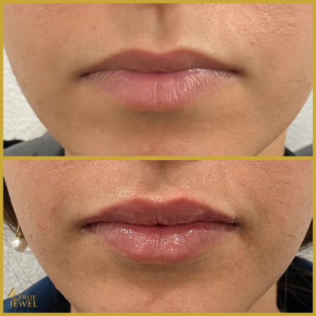 Culver City Lip Filler Before and After 00002