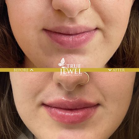 Culver City Lip Filler Before and After 00006
