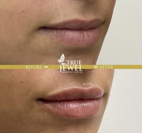 Culver City Lip Filler Before and After 00007