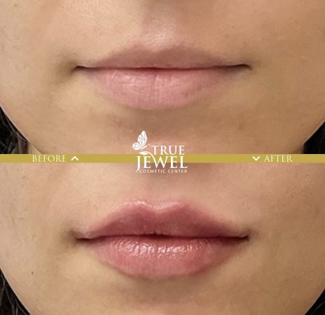 Culver City Lip Filler Before and After 00008