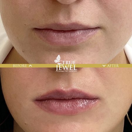Culver City Lip Filler Before and After 00010