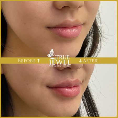 Culver City Lip Filler Before and After 00011