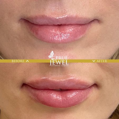 Culver City Lip Filler Before and After 00013