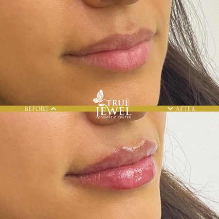 Culver City Lip Filler Before and After 00014